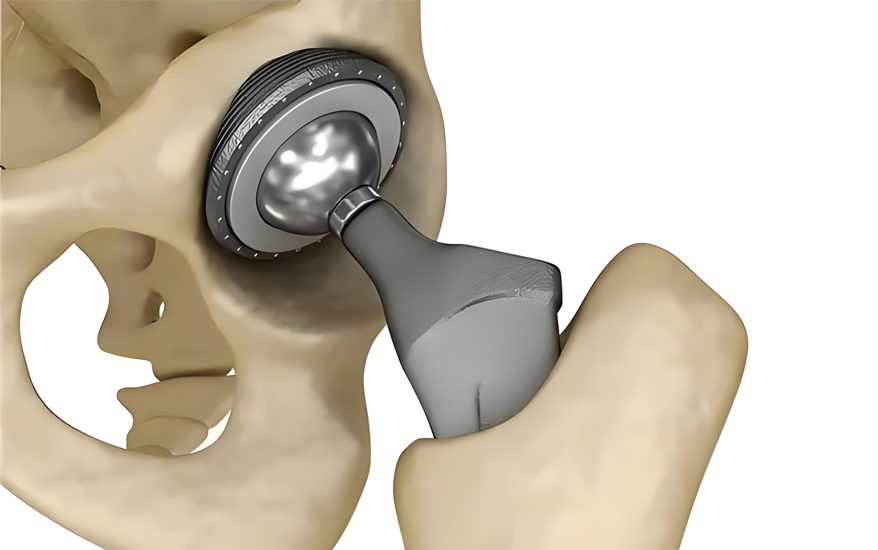 Orthopedic Implants