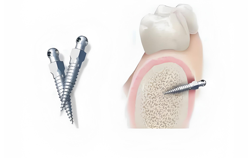 Dental Implant